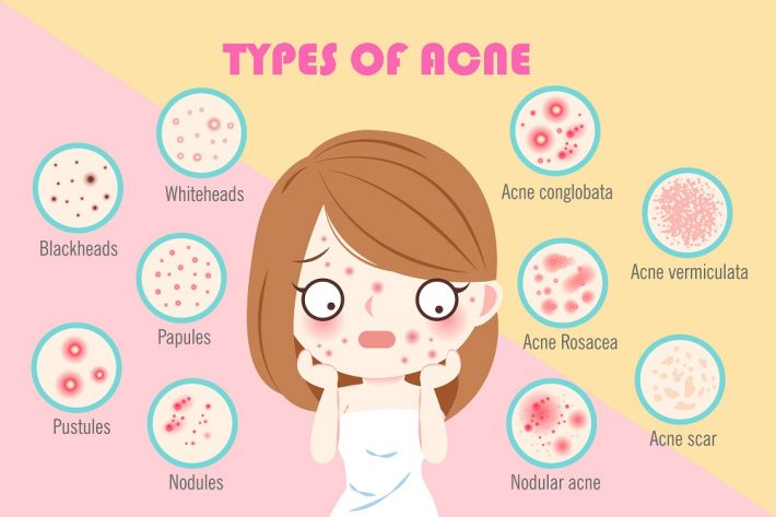 Lactoferrin and Its Effect on Acne - Sovereign Laboratories